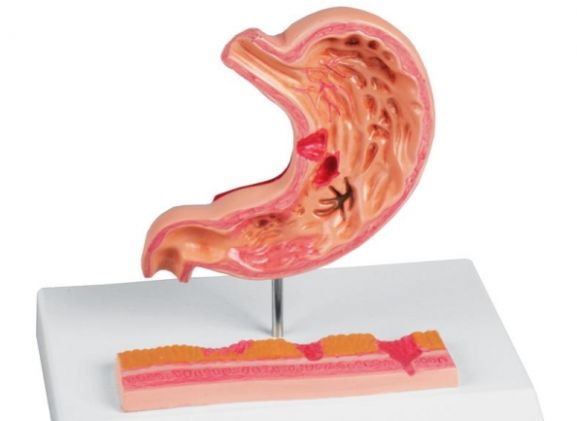 https://jayakelana.jayakelana.id/uploads/product/-k217-stomach-with-ulcers-69392f48960fe9e_cover.jpg