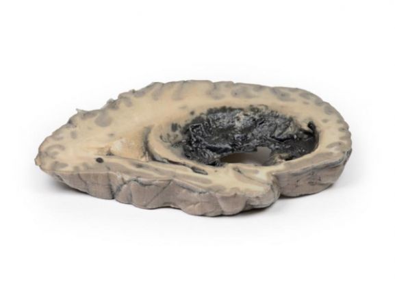 https://jayakelana.jayakelana.id/uploads/product/-mp2002-cerebral-haemorrhage-15458a276d59e8c_cover.jpg