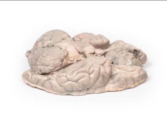 https://jayakelana.jayakelana.id/uploads/product/-mp2004-meningioma-6961502fd874c81_cover.jpg