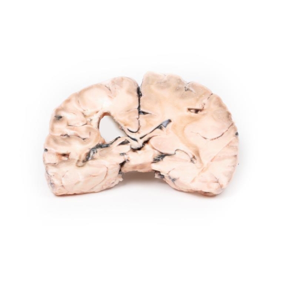 (MP2005) Left Cerebral Infarct