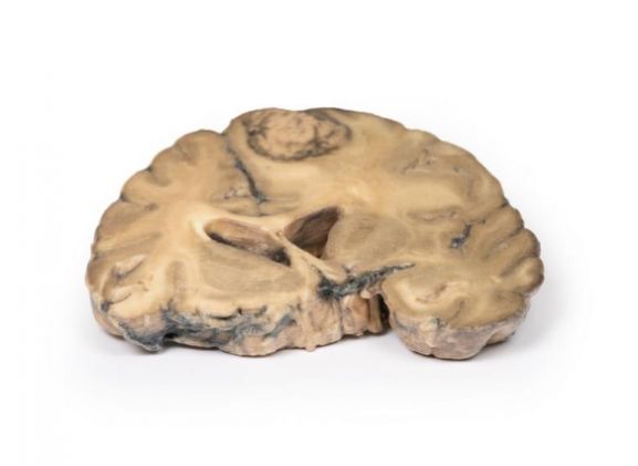 https://jayakelana.jayakelana.id/uploads/product/-mp2007-metastatic-adenocarcinoma-in-681531e669e5ea8_cover.jpg